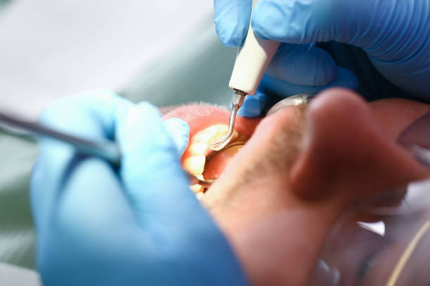 Best Emergency Wisdom Teeth Removal in Clinton, OH